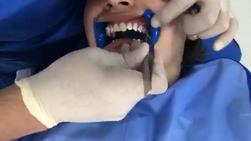 Cementación de Brackets Smile